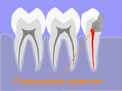 Кариес передается по наследству