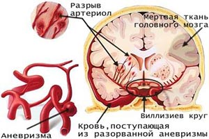 Новая технология удаления тромбов из сосудов головного мозга
